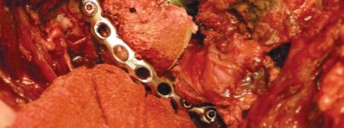 Illustration 51 for Navigating Early THA for Fractures of the Acetabulum