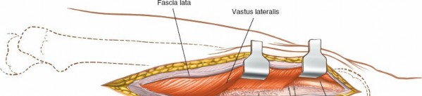 Illustration 20 for Optimal Femoral Approaches: Mastering the Lateral Intermuscular Septum