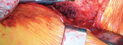 Illustration 22 for Cementless Femoral Stems: Master Indications & Avoid Pitfalls