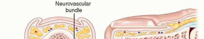 Illustration of paronychia and felons - Dr. Mohammed Hutaif