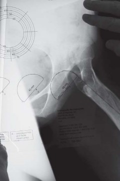 Illustration 13 for Successful Total Hip Replacement in Developmental Dysplasia