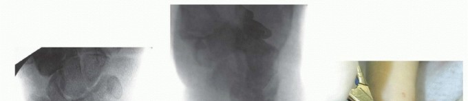 Illustration 13 for Effective K-Wire Fixation: Distal Radius Fractures Without External Fixation