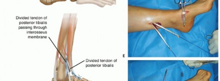 Illustration 18 for How Achilles Tendon Lengthening Fixes Equinocavovarus Foot