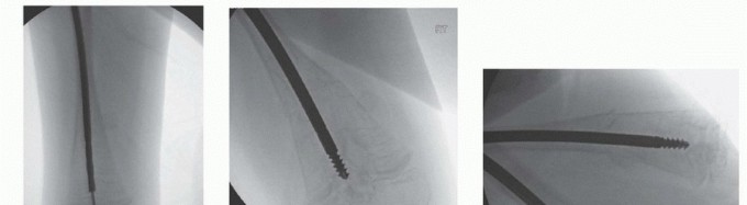 Illustration 17 for Less Pain, More Function: Fassier-Duval Nailing for Osteogenesis Imperfecta