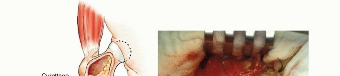 Illustration 12 for Mastering Femoral Metastases: Optimal Function for Femoris & Vastus
