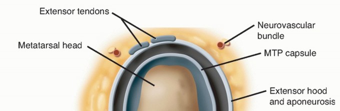 Illustration 4 for Hammer Toe Correction: Understanding the Extensor Digitorum Longus