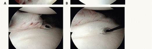 Illustration 17 for Regain Stability: Arthroscopy for Anterior Instability & the Inferior Glenohumeral Ligament