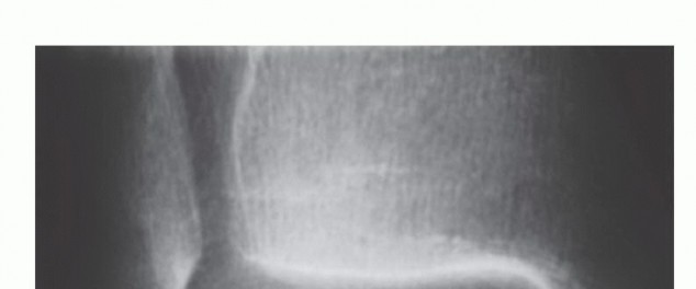Microfracture for OLTs: Why Partial Weight Bearing is Crucial