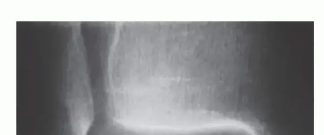 صورة توضيحية لـ آفات الغضروف والعظم في الكاحل (OCLT): دليل شامل للمرضى في اليمن والخليج