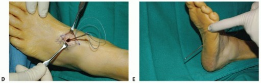 Illustration 37 for Restore Movement: Tendon Transfer for Common Peroneal Nerve Foot Drop