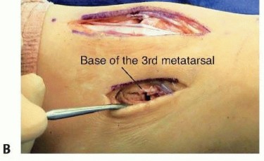 Illustration 16 for Fixation of Lisfranc Injuries: Essential Open Reduction Guide