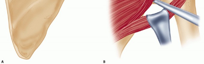 Illustration 32 for Finally Treat Recurrent Posterior Instability of the Shoulder