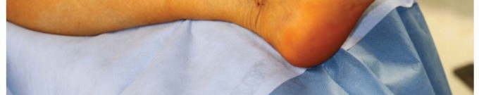 Roto-Glide: Achieve Optimal First Metatarsophalangeal Total Mobility