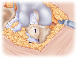 Illustration 24 for Mastering TKA: Essential Methods of Rotational Alignment