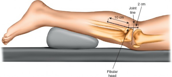 Figure 9: Initial superficial dissection showing subcutaneous tissue.
