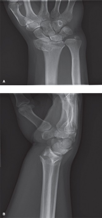 Illustration of case distal radius - Dr. Mohammed Hutaif