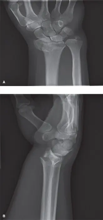 كسر الكعبرة البعيدة المعقدة داخل المفصل: دليل شامل للمرضى في صنعاء