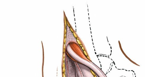Illustration 126 for Optimized Approaches to the Dorsum of the Foot & Ankle