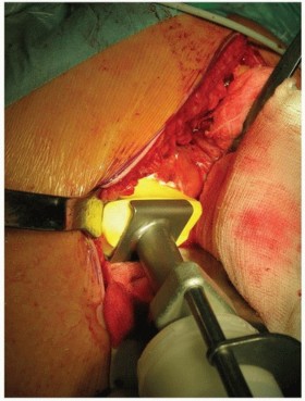 Illustration 31 for Why Polished Tapered Cemented Stems Excel in Hip Replacement