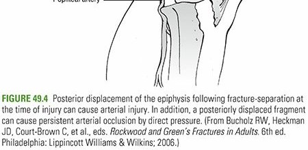 Illustration 24 for Master Pediatric Femoral Shaft & Knee Fractures: Interactive Module