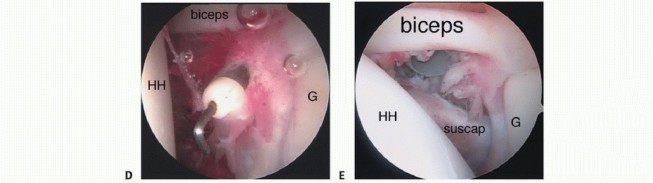 Illustration 14 for Stiff Shoulder? Discover Arthroscopic Capsular Release Solutions