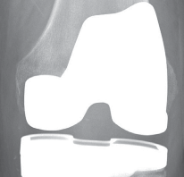 Illustration 18 for The Principles of Revision TKR: Avoid Pitfalls, Ensure Success