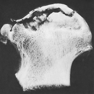 Illustration of conditions of bone - Dr. Mohammed Hutaif