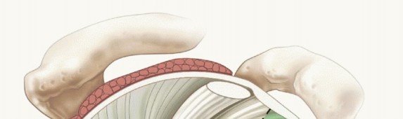Illustration 6 for Regain Stability: Arthroscopy for Anterior Instability & the Inferior Glenohumeral Ligament