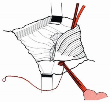Illustration 23 for Sliding Trochanteric Osteotomy: Modern Role & Refined Techniques