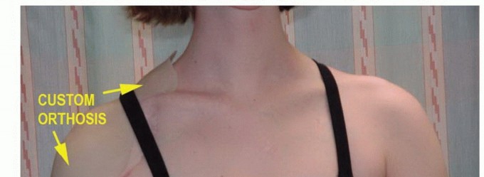 Illustration 37 for Limb-Sparing Resections Around the Shoulder: Optimizing Outcomes