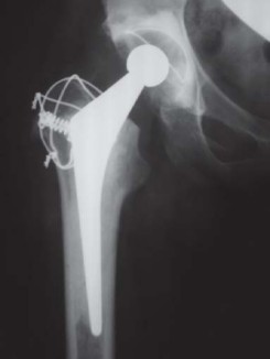 Illustration 6 for Standard Trochanteric Osteotomy: Key to Complex Hip Cases