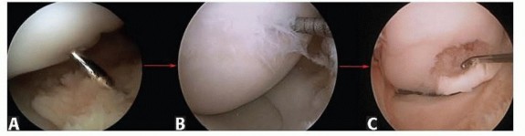 Arthroscopic Drilling & Fixation for Effective OCD Treatment