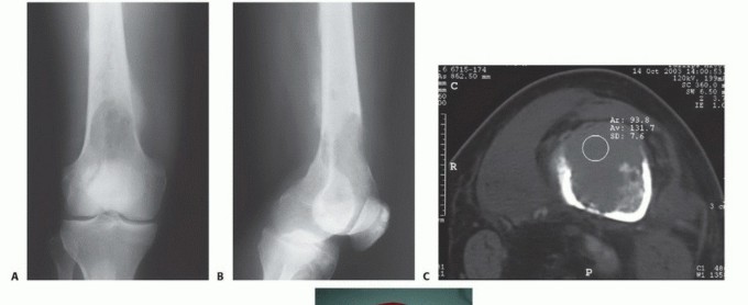 Illustration 18 for Plain Radiograph Showing MBD: Surgical Planning to Prevent Failures