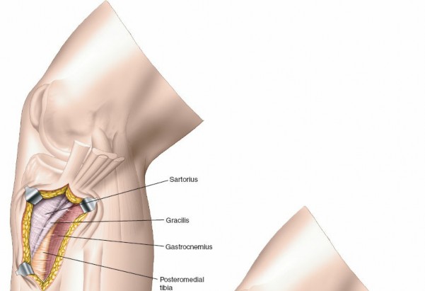 Illustration 19 for Surgical Access: Mastering the Tibia's Surface & Fibula Approaches
