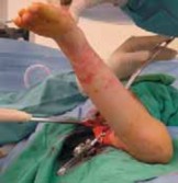 Illustration 31 for Increased Femoral Anteversion: A Proximal Femoral Rotational Osteotomy