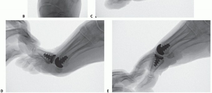 Illustration 58 for End Articular Cartilage Loss: Arthrosurface HemiCAP Resurfacing