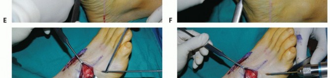Illustration 24 for Mastering Midfoot Arthrodesis: Protect the Deep Neurovascular Bundle