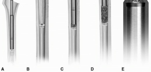 Illustration 22 for Cement in Cement Revision: Simplifying Complex Hip Revisions