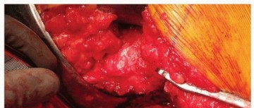 Illustration 18 for Uncemented Acetabular Revision: Optimizing Hemispherical Cup Use