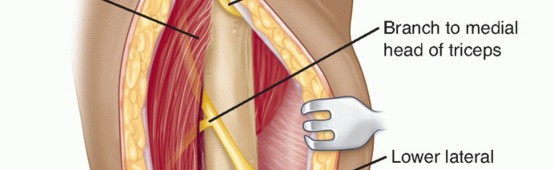 Illustration 24 for Surgical Approaches to Shoulder & Elbow: Pearls and Pitfalls