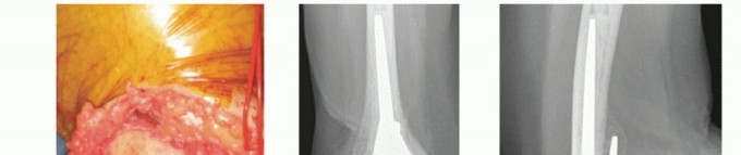 Illustration 28 for Distal Humeral Fractures: When Is Elbow Replacement the Best Option?