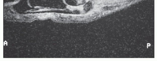 Illustration 13 for Restore Your Foot: Surgical Treatment for Hallux MP Joint Turf Toe