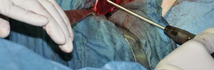 Illustration 30 for Collum Femoris Preserving: Achieve Better Primary Hip Outcomes