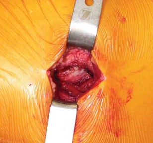 Illustration 15 for Exploring the Ambulatory Surgical Setting for Total Hip Replacement