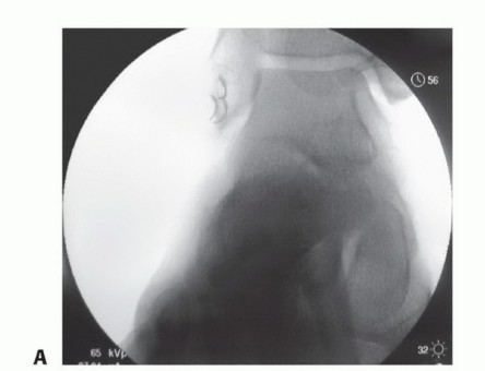 End Chronic Instability: Lateral Ankle Ligament Reconstruction