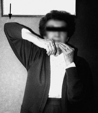 Illustration 2 for Acad Orthop Surg Challenge: Diagnose Shoulder Pain Case 1