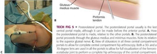 Illustration 216 for Understanding Hip Arthroscopy: The Basics Explained