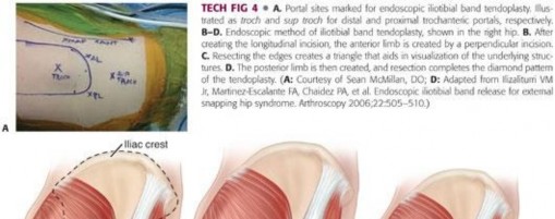Illustration 133 for Stop the Snap: Hip Preservation for Snapping Iliopsoas Tendon