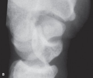 Illustration 6 for Christine M Kleinert Discussion: Solving Difficult Wrist Fractures