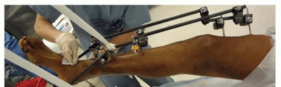 Illustration 12 for Tibia External Fixation: See How Pins Are Placed for Healing
